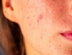 Penderita Autoimun Harus Melakukan ‘Skin Treatment’, Bukan Menggunakan ‘Skincare’