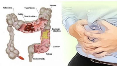 Kanker Usus Bisa Terjadi Karena Sembelit Yang Dibiarkan Terus-menerus